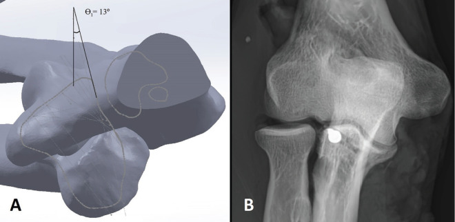 Preventing Proximal Radio-Ulnar Joint Screw Penetration during Coronoid Fracture Fixation: A 3D-Digital Modeling and Cadaver Study.