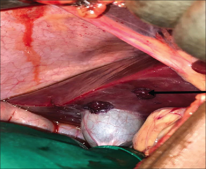 Multiple Gastrointestinal Haemangiomatosis: A Report of Two Cases.