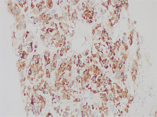 An Unusual Case of Adrenocortical Carcinoma with Multiple Facets.
