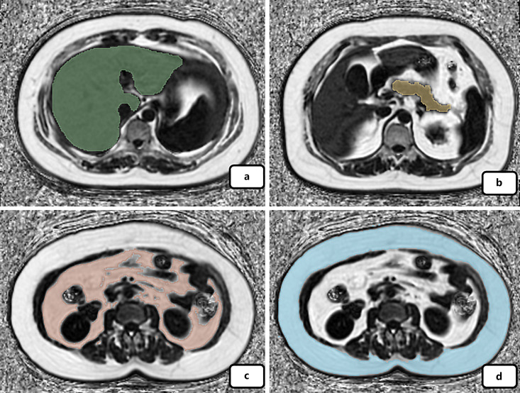 Behind BMI: The Potential Indicative Role of Abdominal Ectopic Fat on Glucose Metabolism.