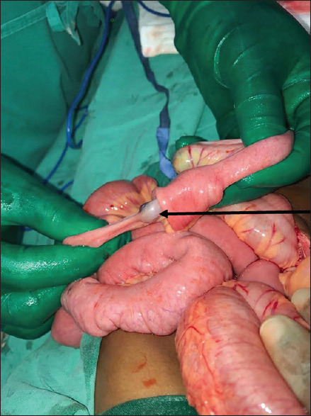 Multiple Gastrointestinal Haemangiomatosis: A Report of Two Cases.