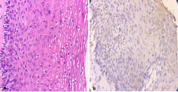 Role of CK7 Immunoreactivity in Predicting Progression of the Cervical Intraepithelial Neoplasia: A Retrospective Cross-sectional Study.