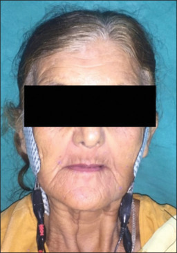 Effect of a centric stabilization splint on masticatory muscles in patients with temporomandibular disorders: An electromyographic study.