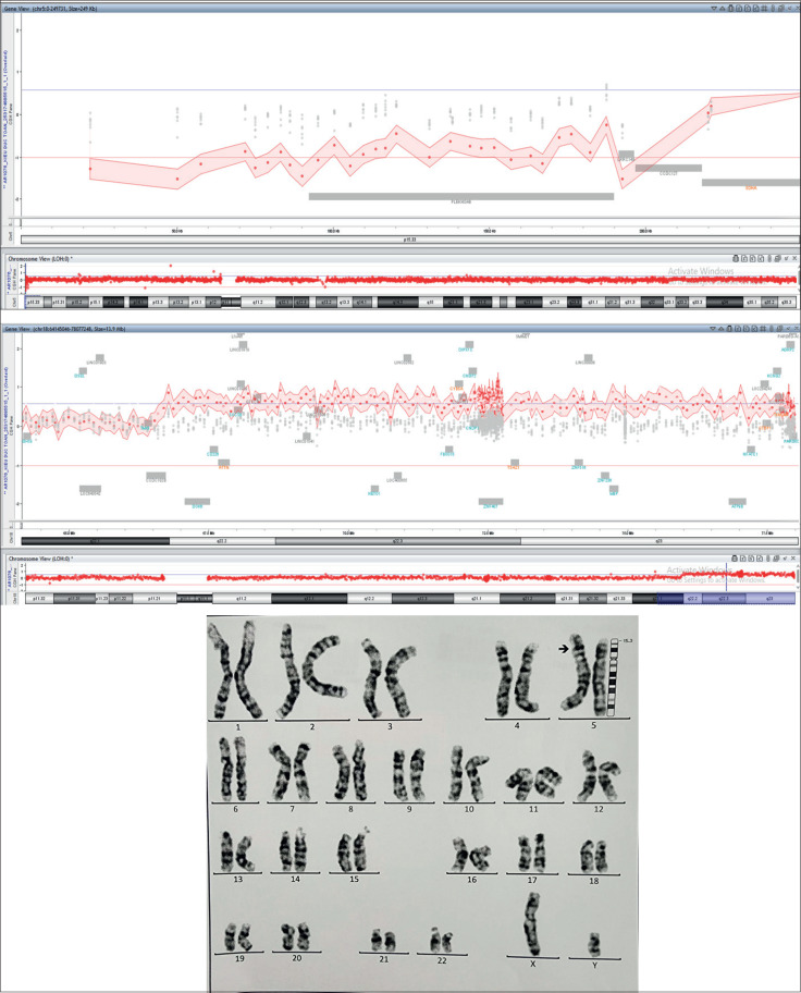 Unbalanced Translocation in a Phenotypically Normal Male Patient Detected by Karyotyping and Array-comparative Genomic Hybridization.