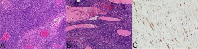 A rare presentation of thyroid malignant peripheral nerve sheath tumor in neurofibromatosis type 1 delineated by FDG PET/CT: A case report and literature review.
