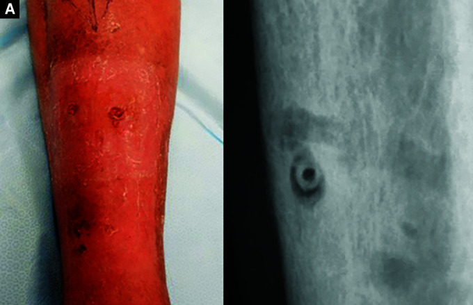 Clinical Outcome following Management of Severe Osteomyelitis due to Pin Site Infection.