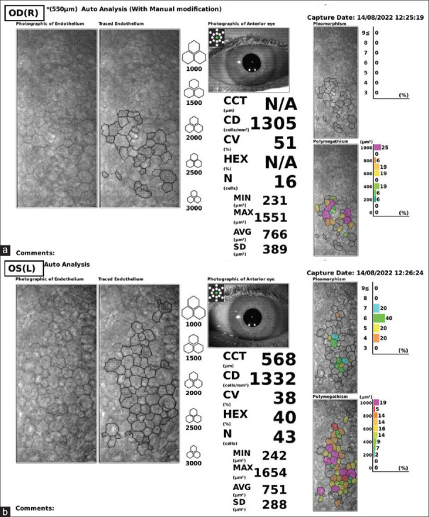 Corneal Endothelial Toxicity Secondary to Topical 5-fluorouracil.