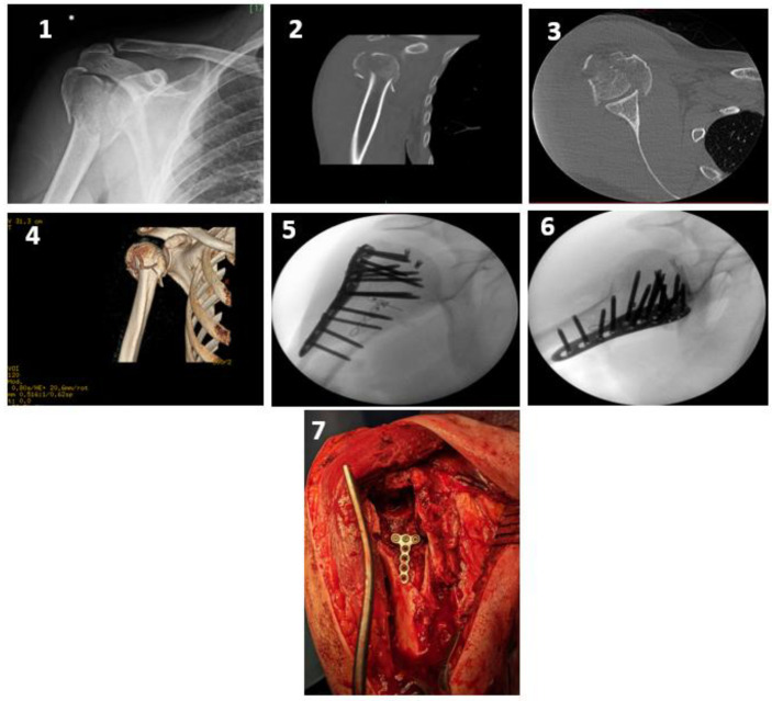 Intramedullary Plating of Complex Proximal Humerus Fractures: A Case Series.