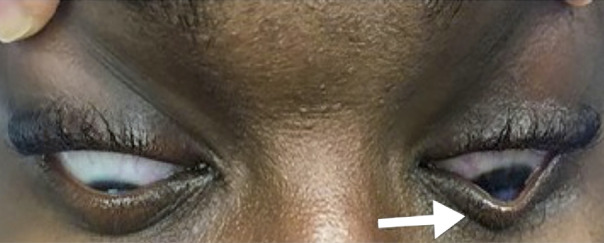 Keratoconus: an introduction.