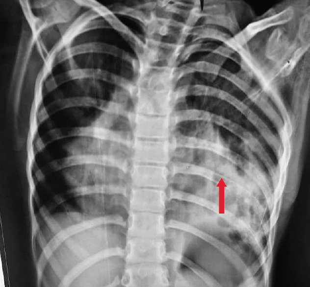 Hybrid Pulmonary Sequestration, Cystic Pulmonary Adenomatoid Malformation, and Dextrocardia: A Triple Whammy.