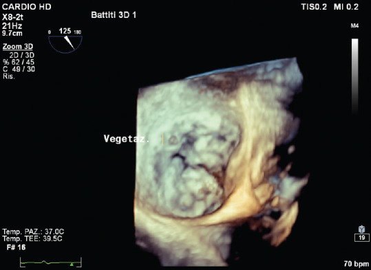 Three-dimensional Transesophageal Echocardiography in Infective Endocarditis: What Does It Add?