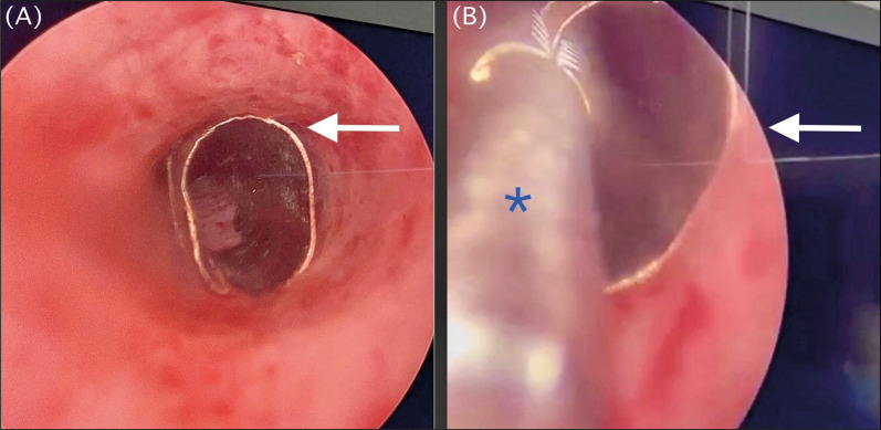 Breakage and detachment of the rigid cystoscope's distal tip: an unusual case of urological instrument malfunction.