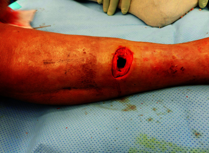 Clinical Outcome following Management of Severe Osteomyelitis due to Pin Site Infection.