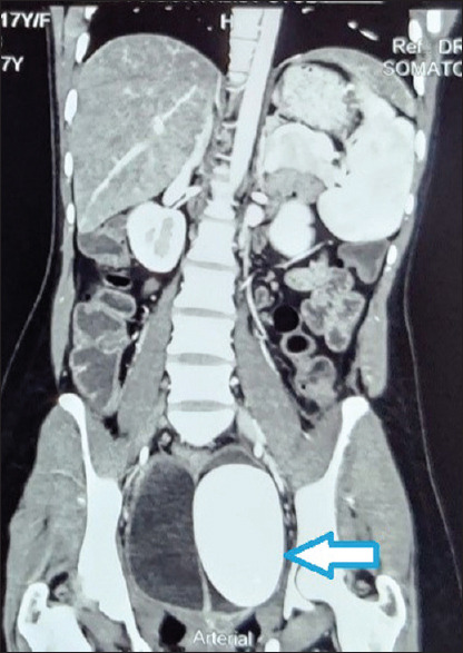 Giant Colpolithiasis in Urogenital Sinus Anomaly with Urethral Duplication: A Case Report and Review of Literature.