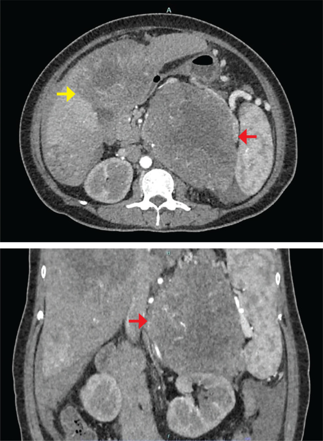 An Unusual Case of Adrenocortical Carcinoma with Multiple Facets.