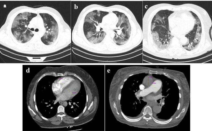 The association of radiologic right heart strain indices with the severity of pulmonary parenchymal involvement and prognosis in patients with COVID-19.