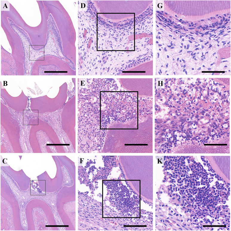 Acute pulpitis promotes purinergic signaling to induce pain in rats via P38MAPK/NF-κB signaling pathway.