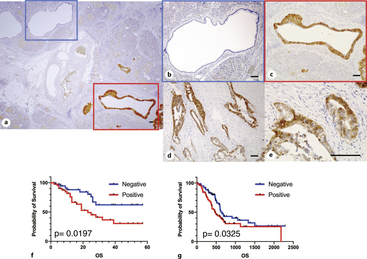 IQ Motif Containing GTPase-Activating Protein 3 Is Associated with Cancer Stemness and Survival in Pancreatic Ductal Adenocarcinoma.