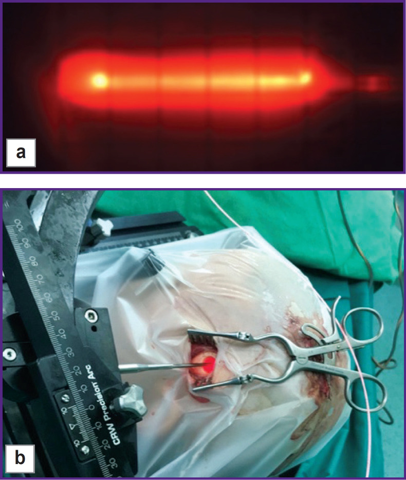 Stereotactic Photodynamic Therapy of Recurrent Malignant Gliomas.