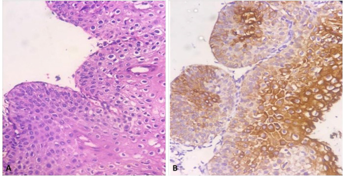 Role of CK7 Immunoreactivity in Predicting Progression of the Cervical Intraepithelial Neoplasia: A Retrospective Cross-sectional Study.