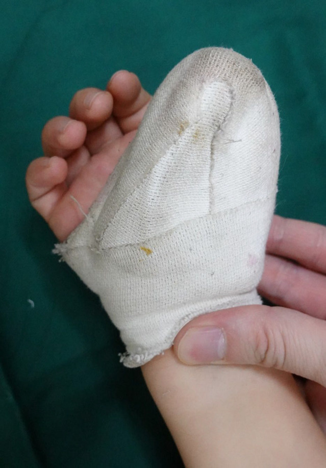 A Bulky Dressing Immobilization for the Congenital Hand Differences in Children.