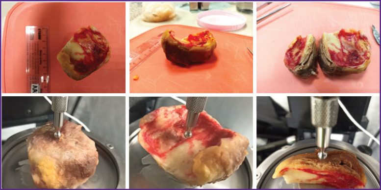 Potential of Current Direct Mechanical Testing Methods in Assessing Intraoperative Samples of Aortic Aneurysm Caused by Uncontrolled Arterial Hypertension.