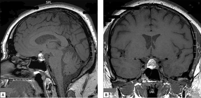 [Development of sarcoidosis after successful treatment of Cushing's disease].