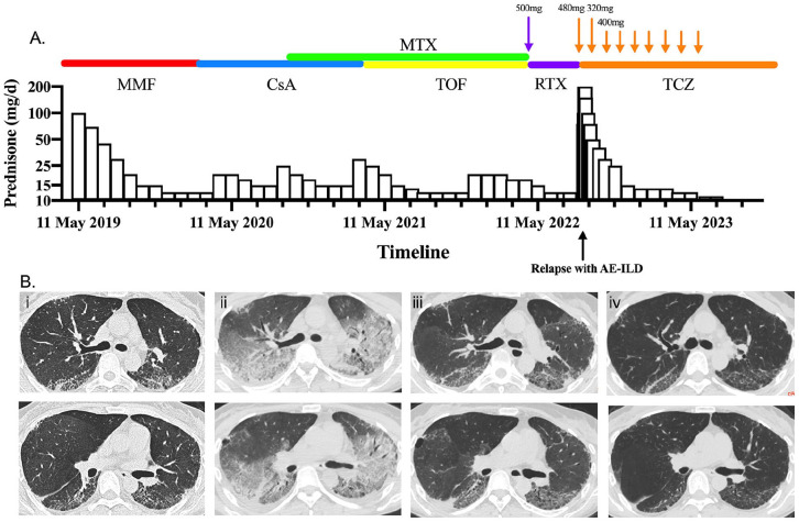Tocilizumab Treatment in a Patient of Refractory Anti-EJ Positive ASyS: A Case Report.
