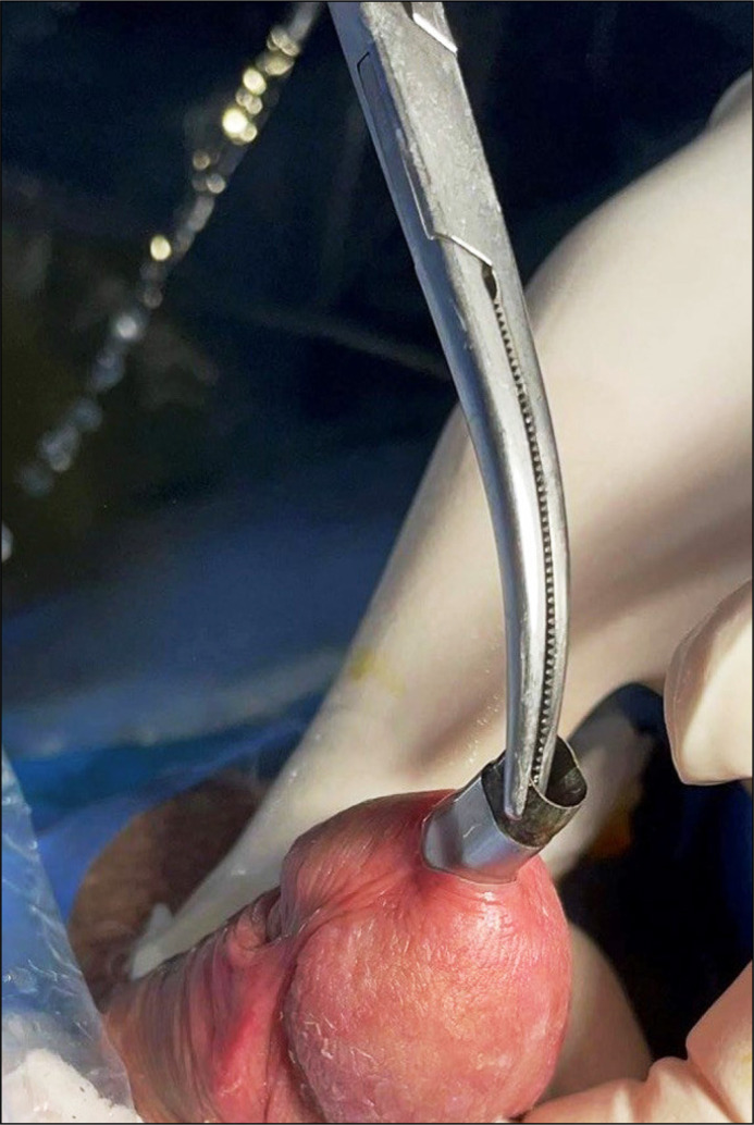 Breakage and detachment of the rigid cystoscope's distal tip: an unusual case of urological instrument malfunction.