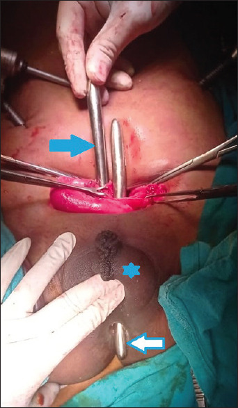 Giant Colpolithiasis in Urogenital Sinus Anomaly with Urethral Duplication: A Case Report and Review of Literature.