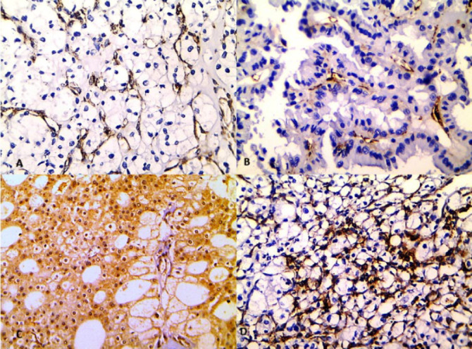 Regulation of Tumor Vascular Microenvironment by Nestin and Fms-related Tyrosine Kinase 1 (FLT1) and Their Prognostic Significance in Renal Cell Carcinoma.