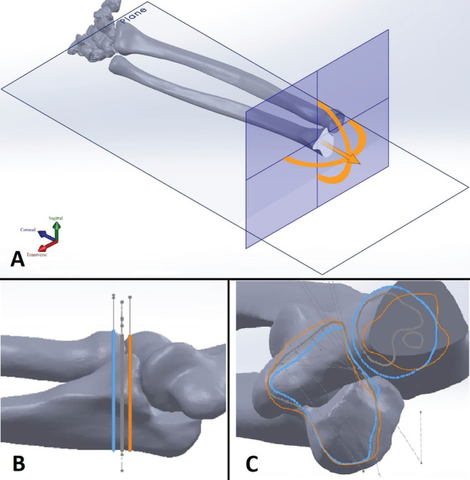 Preventing Proximal Radio-Ulnar Joint Screw Penetration during Coronoid Fracture Fixation: A 3D-Digital Modeling and Cadaver Study.