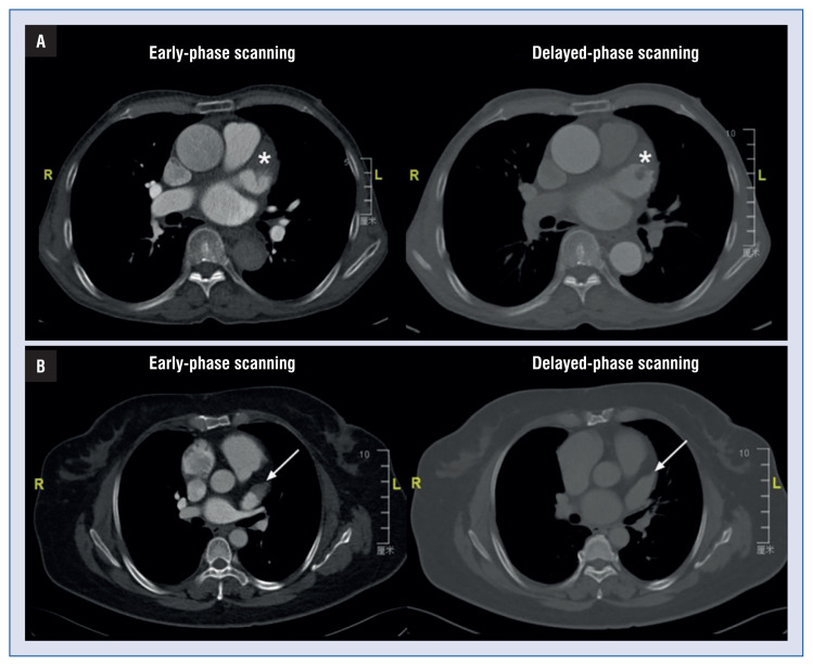 Left atrial appendage filling defect in exclusive early-phase scanning of dual-phase cardiac computed tomography: An indicator for elevated thromboembolic risk.