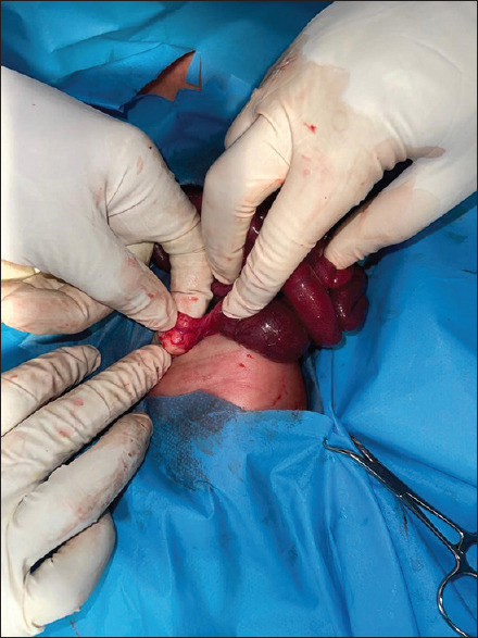 Penile Agenesis Associated with Anorectal Malformation and Bilateral Renal Agenesis: A Case Report and a Review of the Literature.