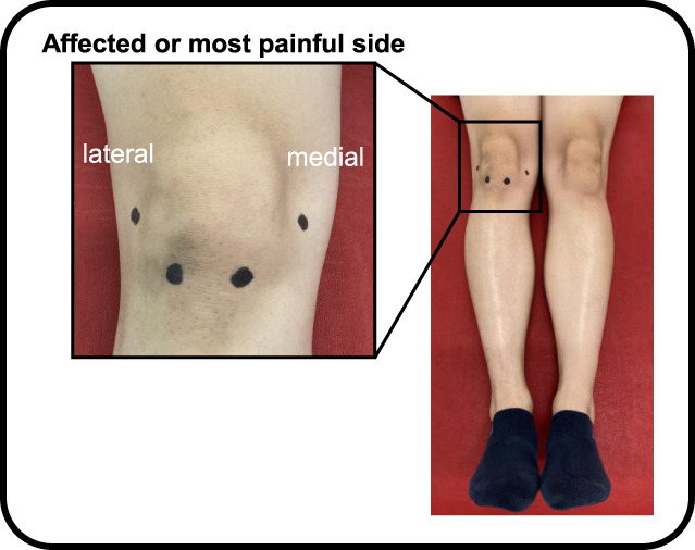 Pathology of knee osteoarthritis pain: contribution of joint structural changes and pain sensitization to movement-evoked pain in knee osteoarthritis.