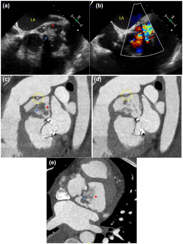 Relevance of cardiac imaging in the evolving landscape of infective endocarditis management.