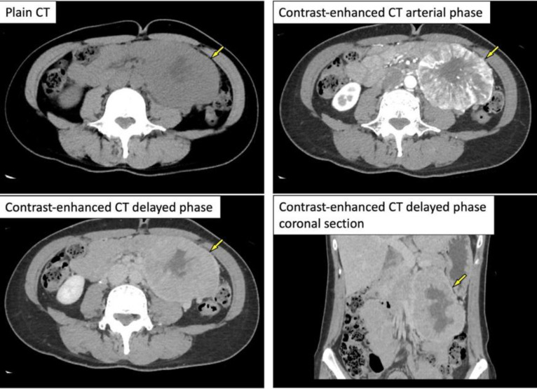 Effectiveness of <sup>18</sup>F-FDG PET/CT in finding lung metastasis from a retroperitoneal paraganglioma.