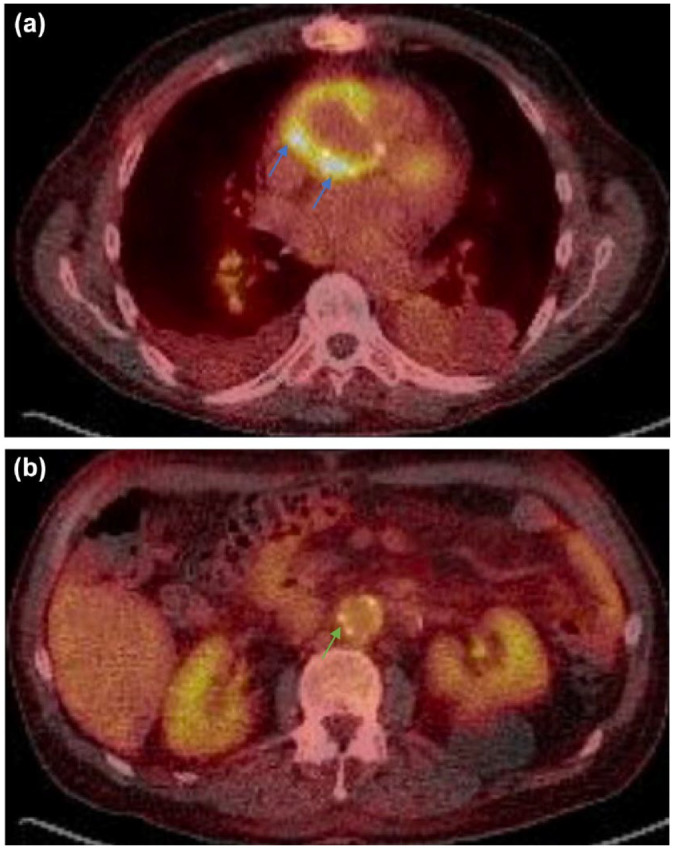 Relevance of cardiac imaging in the evolving landscape of infective endocarditis management.