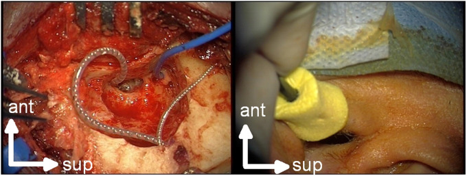 Does Intraoperative Extracochlear Electrocochleography Correlate With Postoperative Audiometric Hearing Thresholds in Cochlear Implant Surgery? A Retrospective Analysis of Cochlear Monitoring.