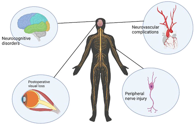 Critical Assessment of the Neurological Complications during High-Risk Anesthesia Procedures.