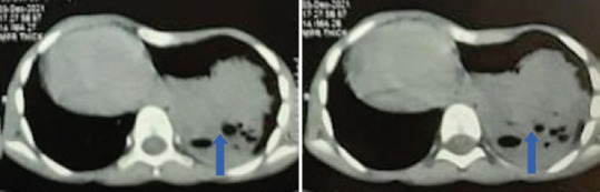 Hybrid Pulmonary Sequestration, Cystic Pulmonary Adenomatoid Malformation, and Dextrocardia: A Triple Whammy.