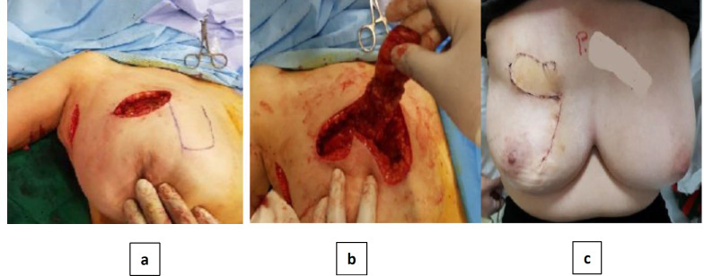 Medial Breast Reconstruction after Breast Conserving Surgery with Local Flap: A Single Center Experience.