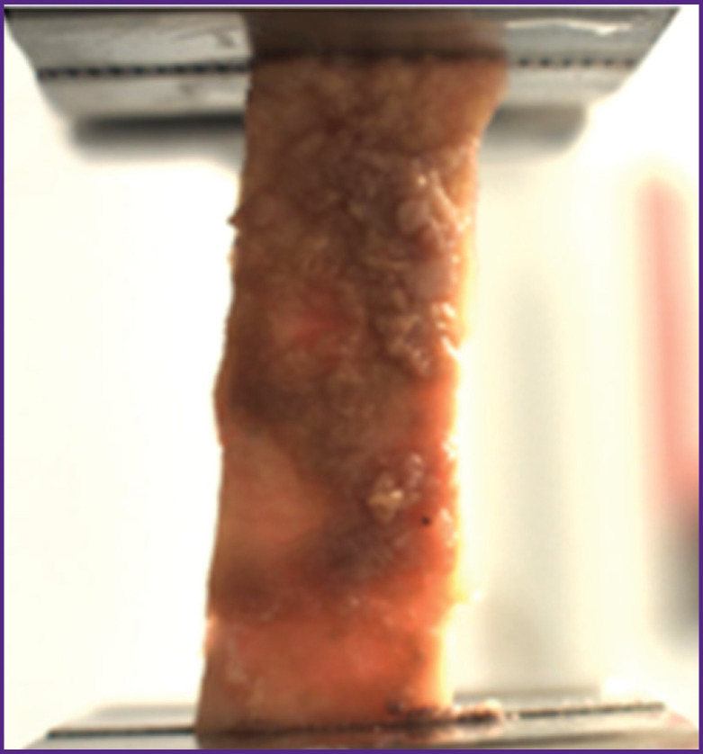 Potential of Current Direct Mechanical Testing Methods in Assessing Intraoperative Samples of Aortic Aneurysm Caused by Uncontrolled Arterial Hypertension.