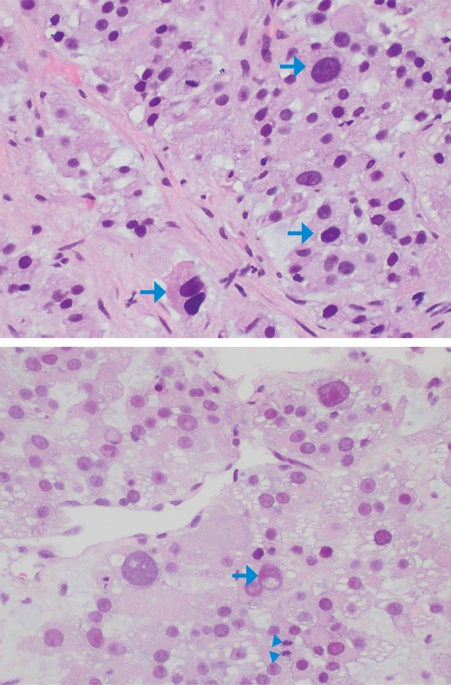 An Unusual Case of Adrenocortical Carcinoma with Multiple Facets.