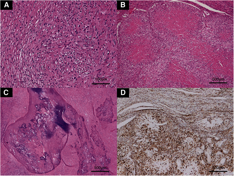 Thoracoscopic Wedge Resection for Low-Grade Fibromyxoid Sarcoma (Evans Tumor) with Massive Calcification and Originating from the Lung: A Rare Case in an Unexpected Location.