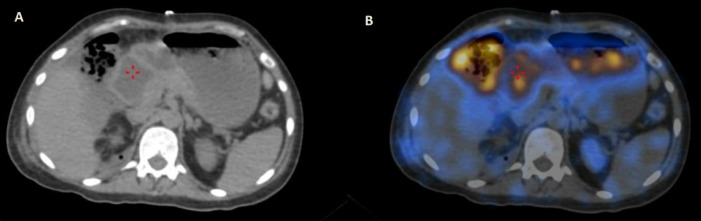 Incidental diagnosis of intestinal perforation on a <sup>99m</sup>Tc DTPA renogram.