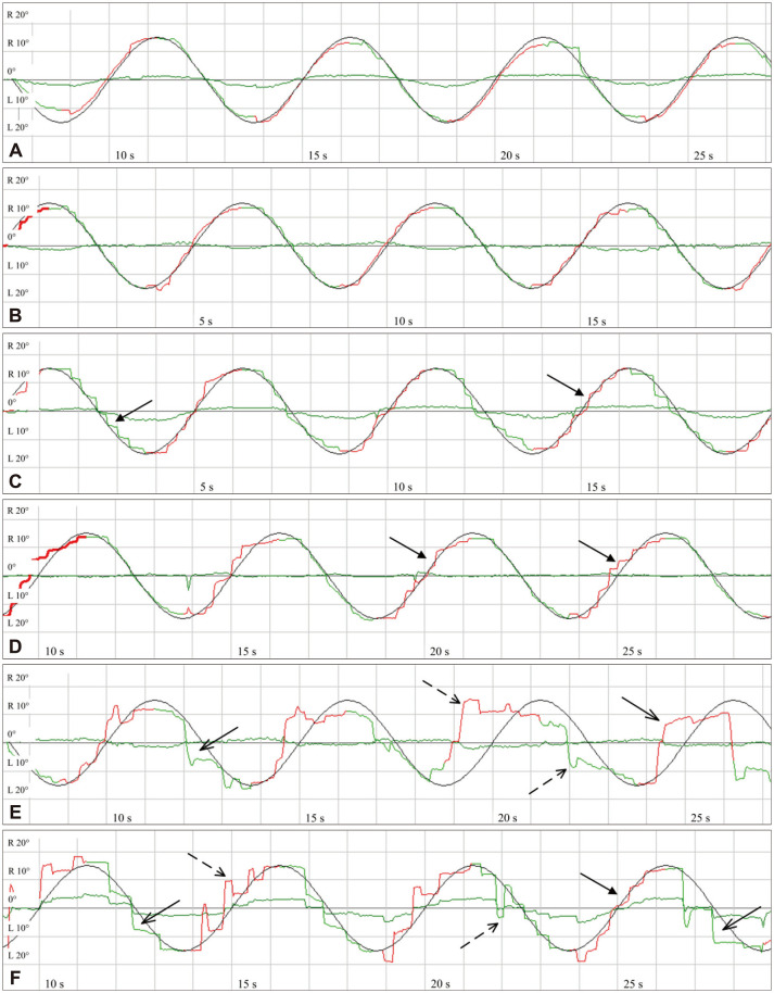Abnormal Ocular Movement in the Early Stage of Multiple-System Atrophy With Predominant Parkinsonism Distinct From Parkinson's Disease.