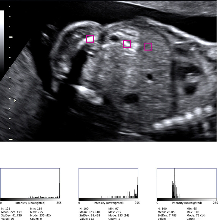 Fetal Echogenic Bowel: What Is Real Echogenicity? A Quantitative Method Based on Histogram Analysis of the Grayscale.