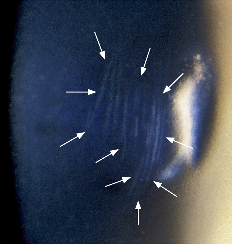 Keratoconus: an introduction.