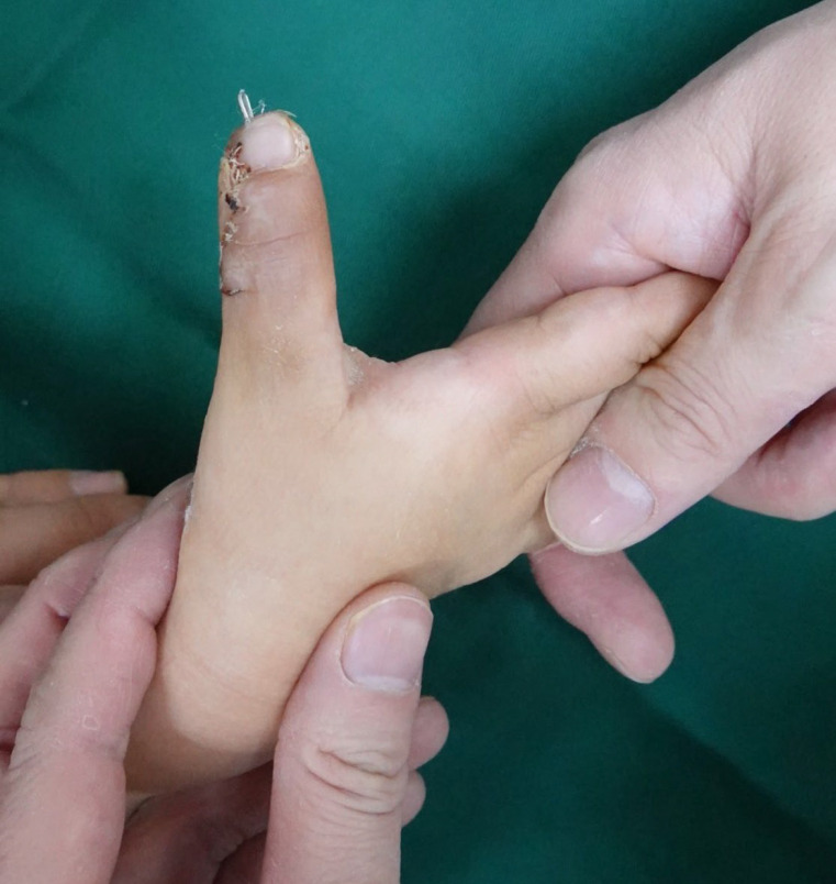 A Bulky Dressing Immobilization for the Congenital Hand Differences in Children.